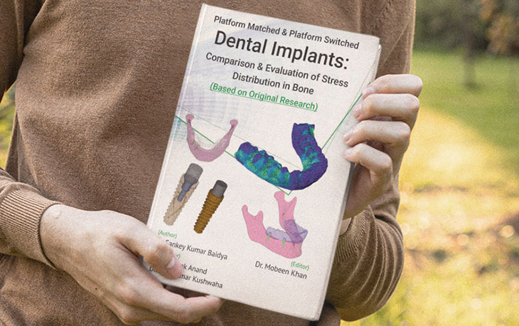Platform Matched & Platform Switched Dental Implants Comparison